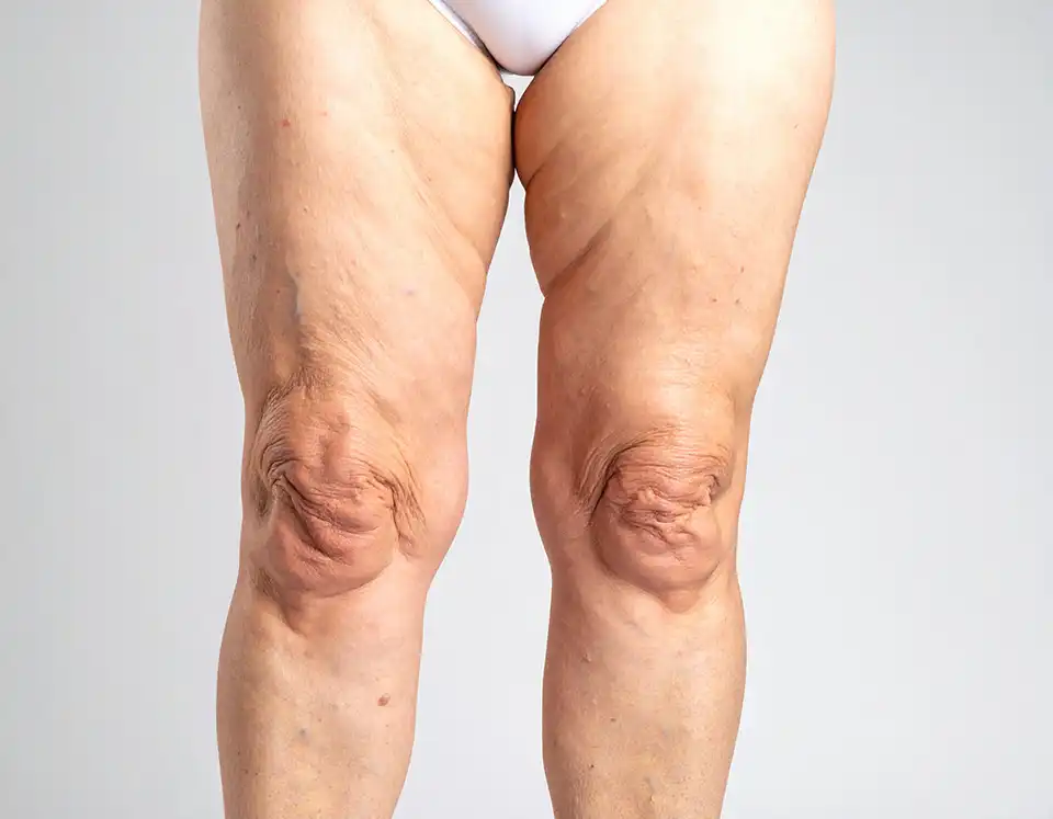 4D lipo elle n’est pas adaptée au traitement du lipœdème