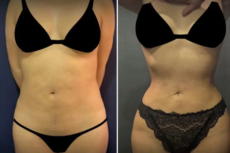 Chirurgie RIBXCAR en Tunisie