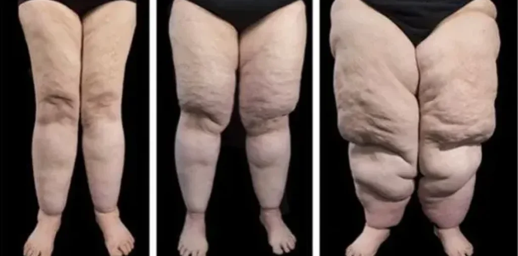 Chirurgie du Lipœdème en Tunisie