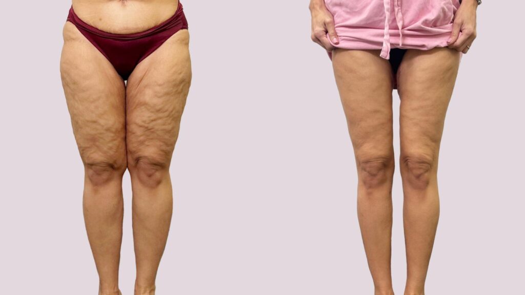 High Definition Lipedema Surgery