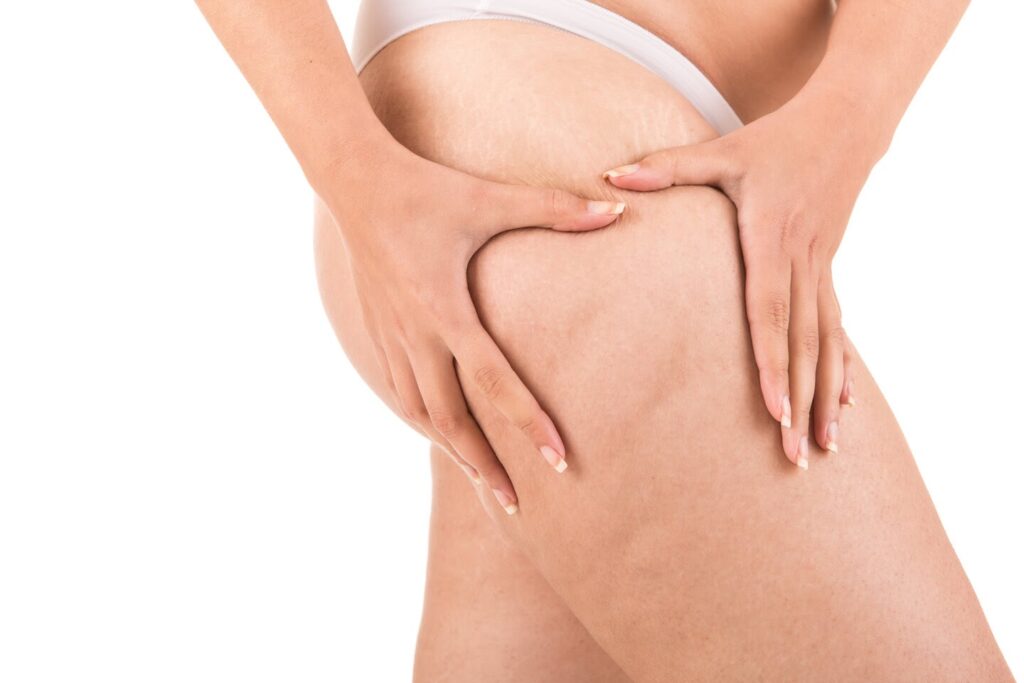 Traitement du Lipœdème par Liposuccion VASER