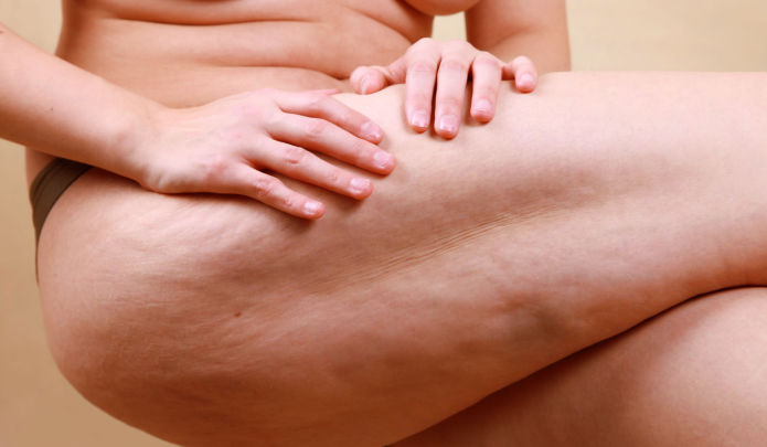 Traitement du Lipœdème par Liposuccion WAL en Tunisie