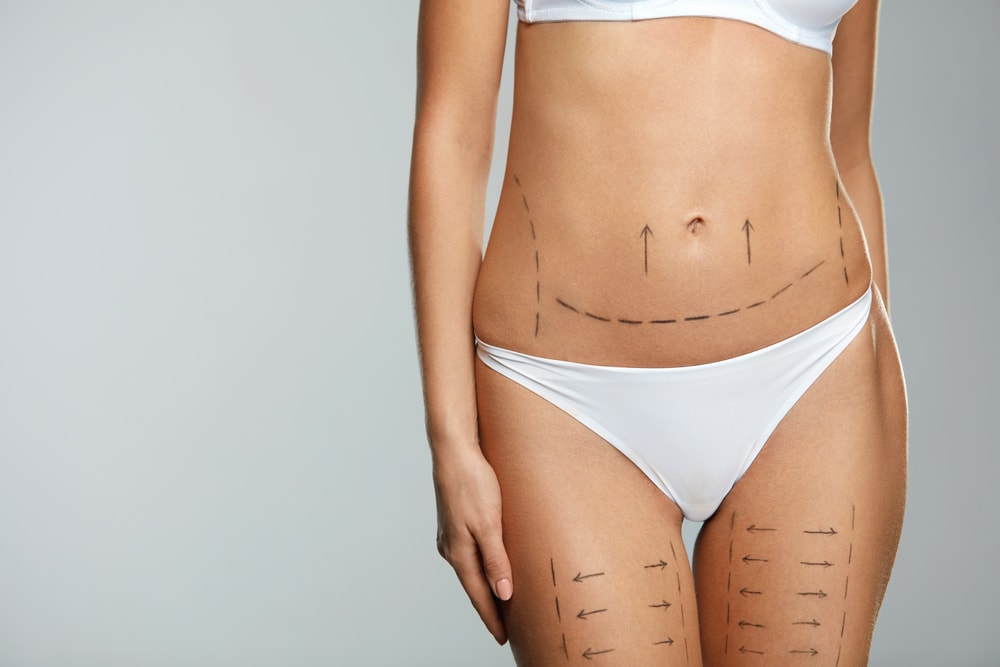 Traitement du lipœdème par BodyTite