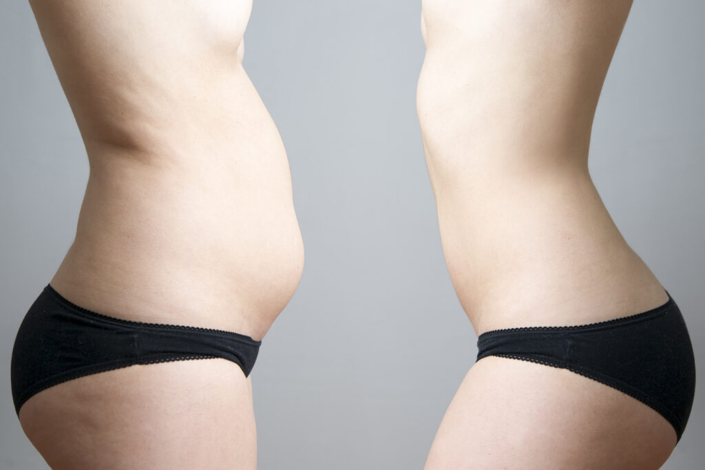 Liposuccion VASER ou WAL