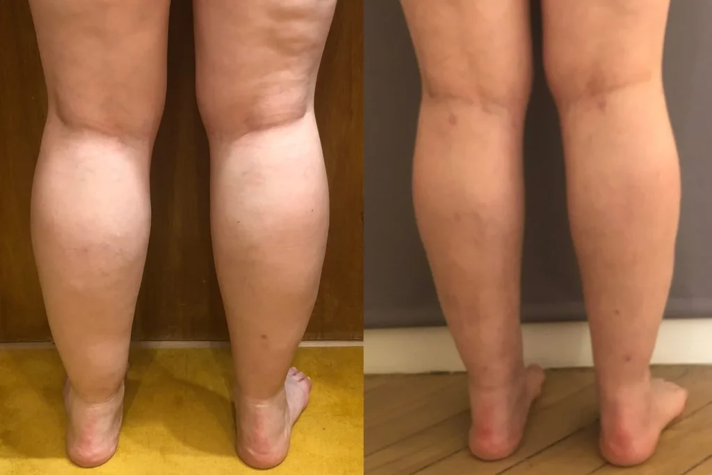 Remodelage complet des jambes après traitement du lipœdème