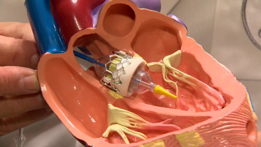 Chirurgie des valves cardiaques