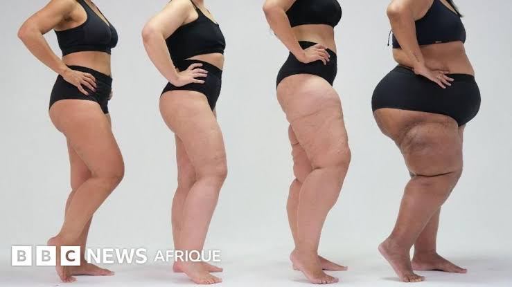 Chirurgie du lipœdème