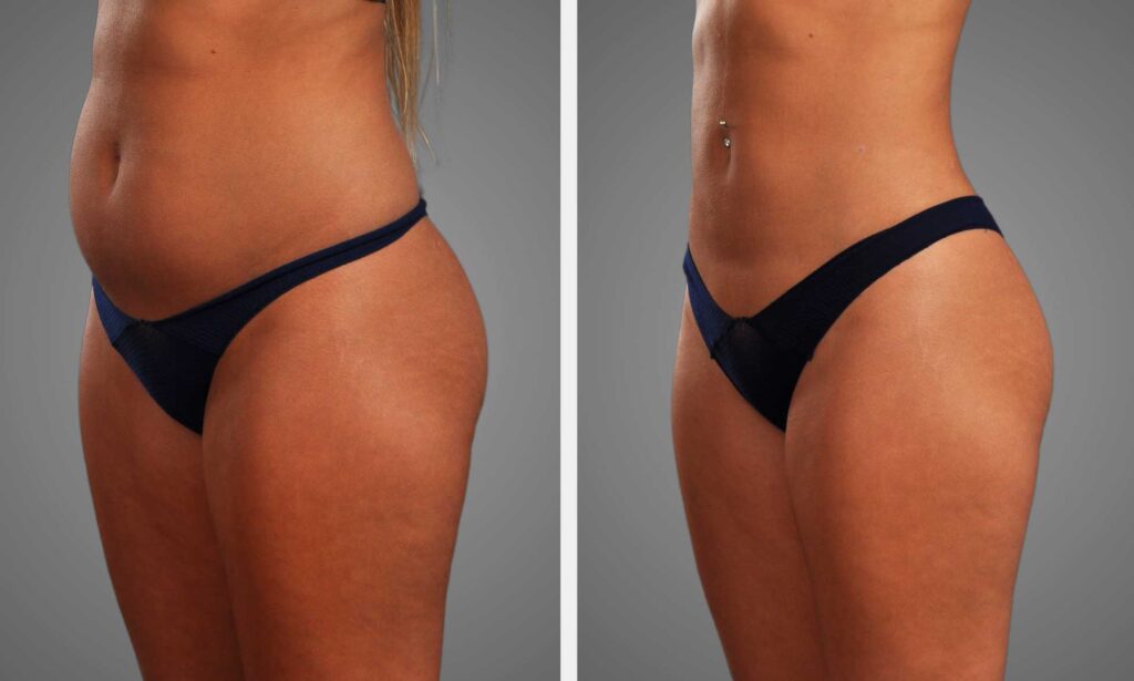 Liposuccion WAL vs PAL