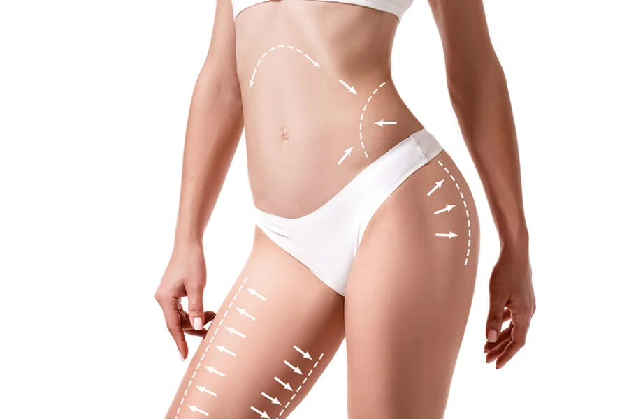 Liposuccion du lipœdème vs liposuccion esthétique classique