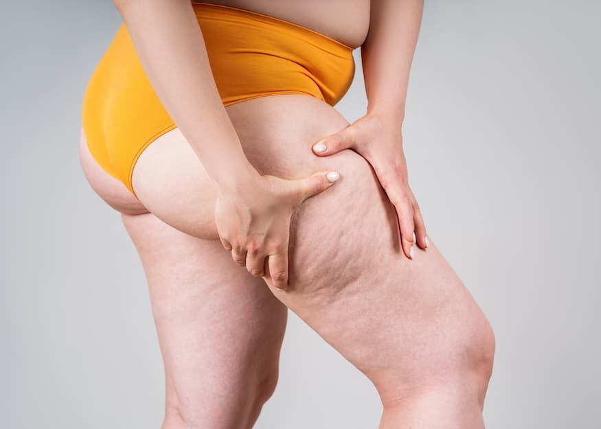 Pourquoi le lipœdème ne disparaît pas avec le sport et la perte de poids ?