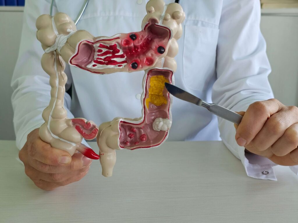 Chirurgie du côlon
