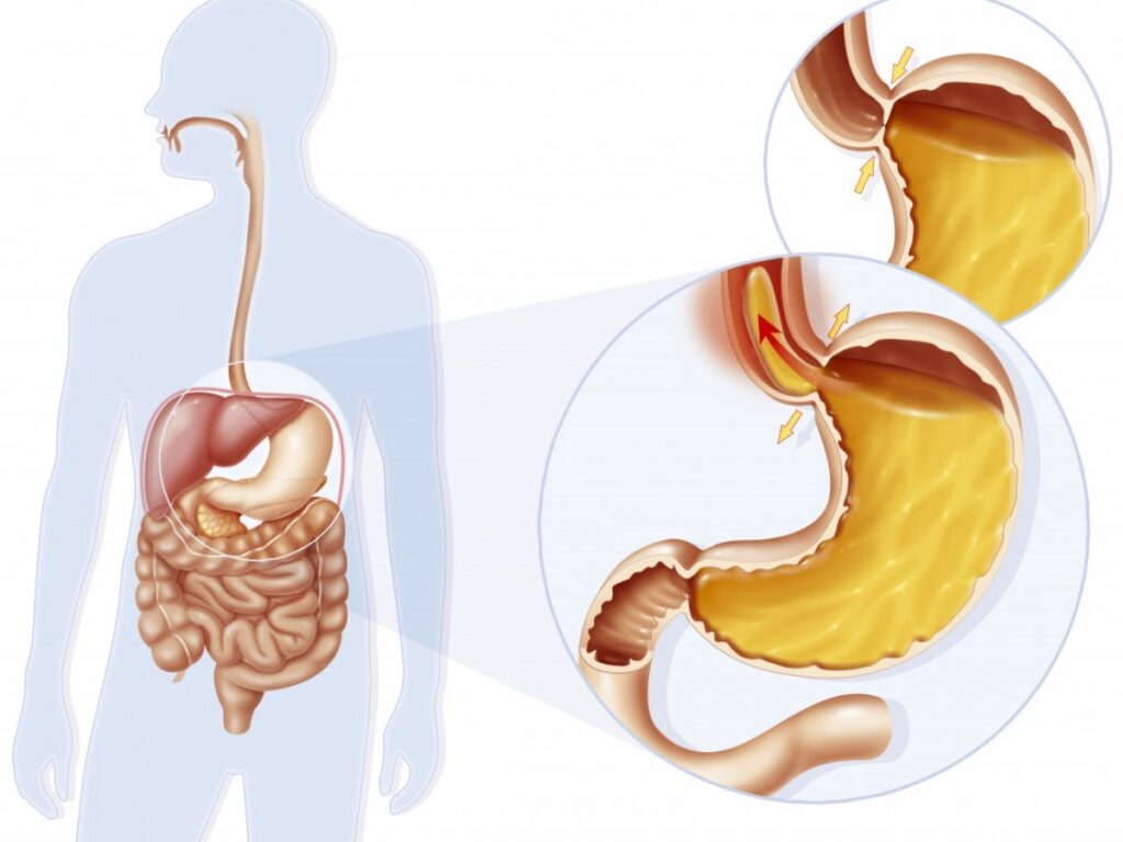 Chirurgie du reflux gastro-œsophagien