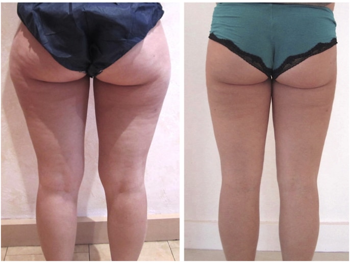 Lipœdème des hanches et culottes de cheval