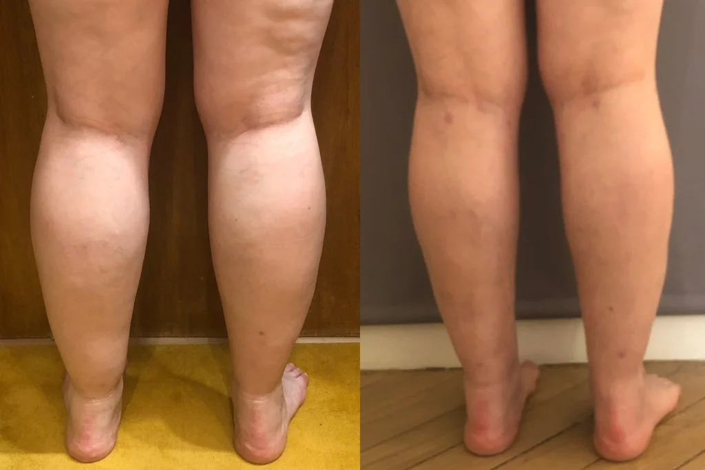 Liposuccion 4-Tech du lipœdème
