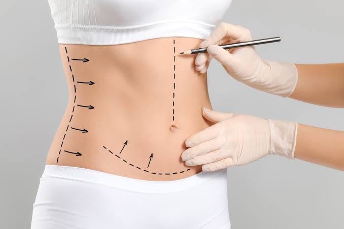 Liposuccion et body contouring personnalisé