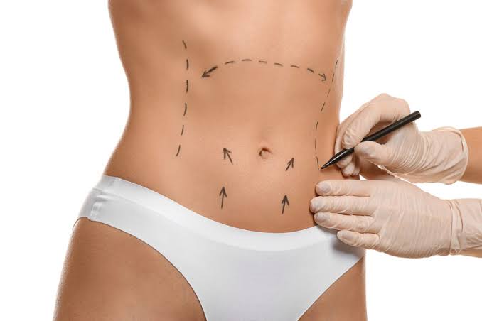 Liposuccion haute définition (HD) et lipœdème
