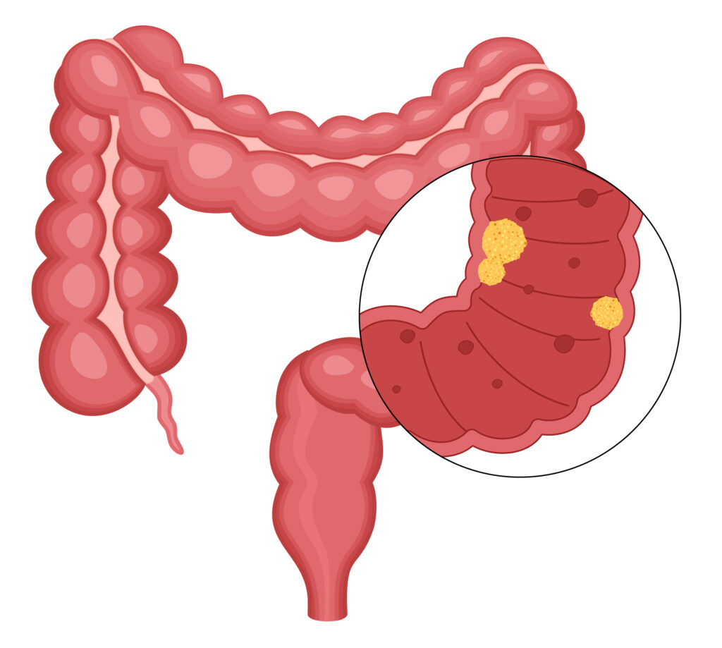 Chirurgie colorectale en Tunisie