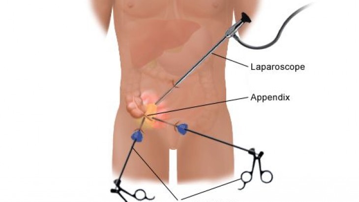 Chirurgie de l’appendicite par laparoscopie