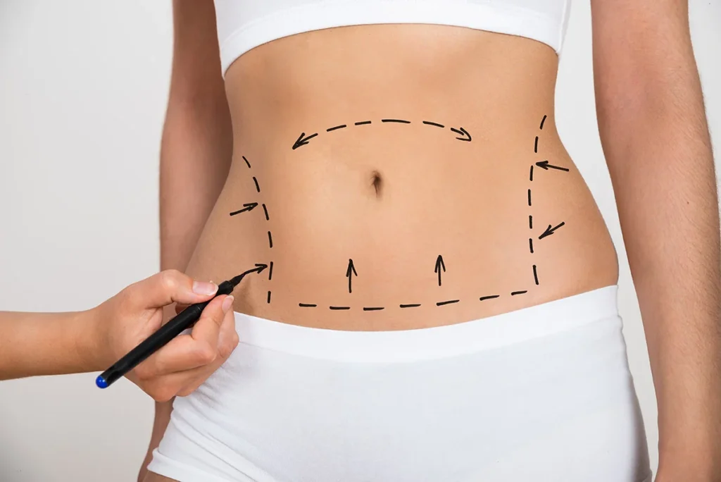 Liposculpture HD avec BodyTite en Tunisie