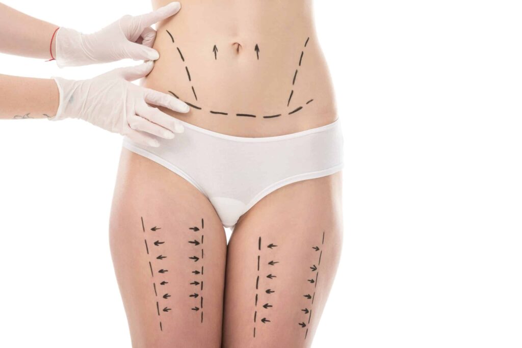 Liposuccion 360° et BBL