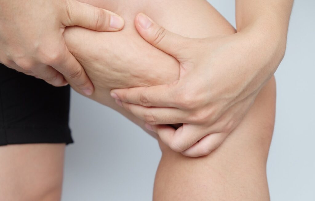 Liposuccion haute définition du lipœdème