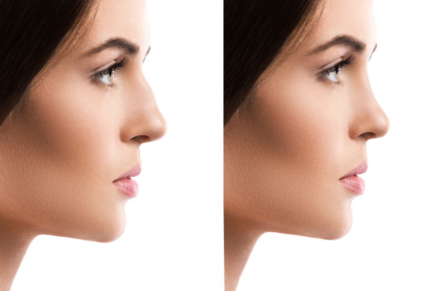 Rhinoplastie esthétique