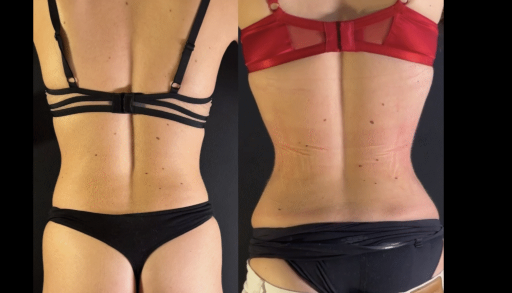 RibXcar et liposuccion des flancs