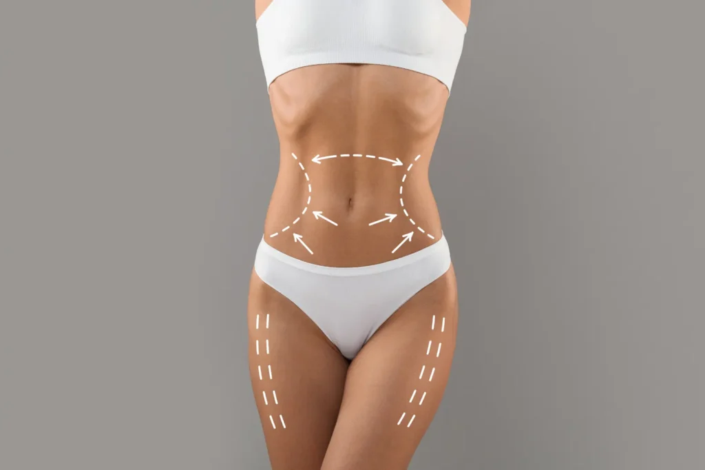 Lipofilling mammaire et liposuccion 360°