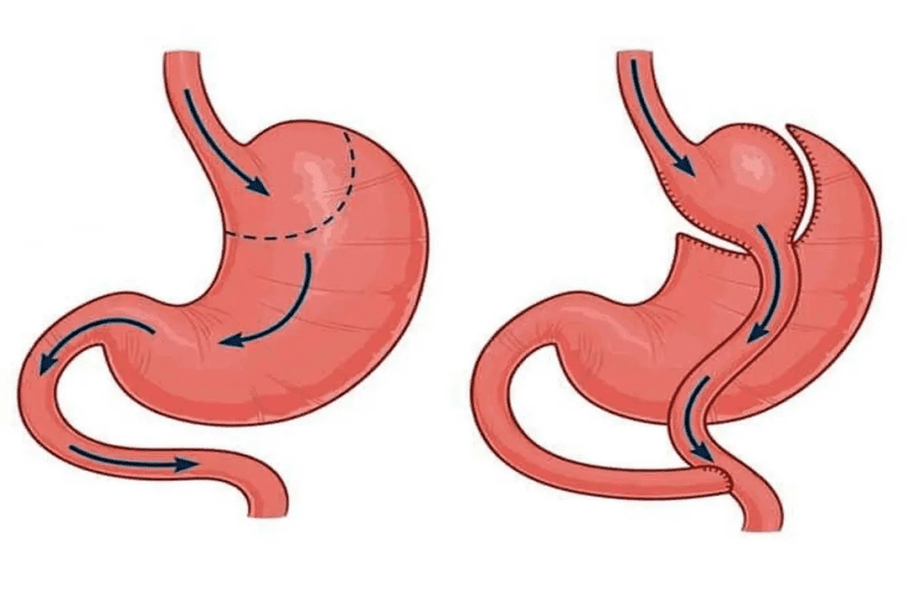 Sleeve vs Bypass Gastrique